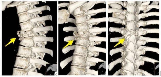 Nowatorska operacja naszych neurochirurgów